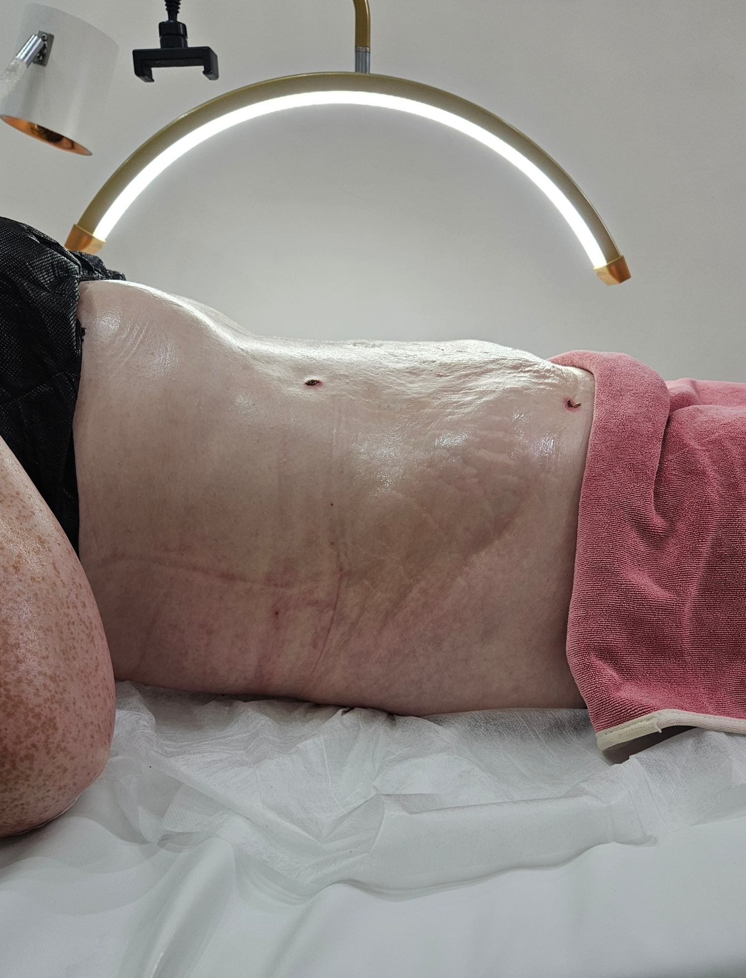 Post-surgical lymphatic drainage massage on the abdomen at the Enfield clinic