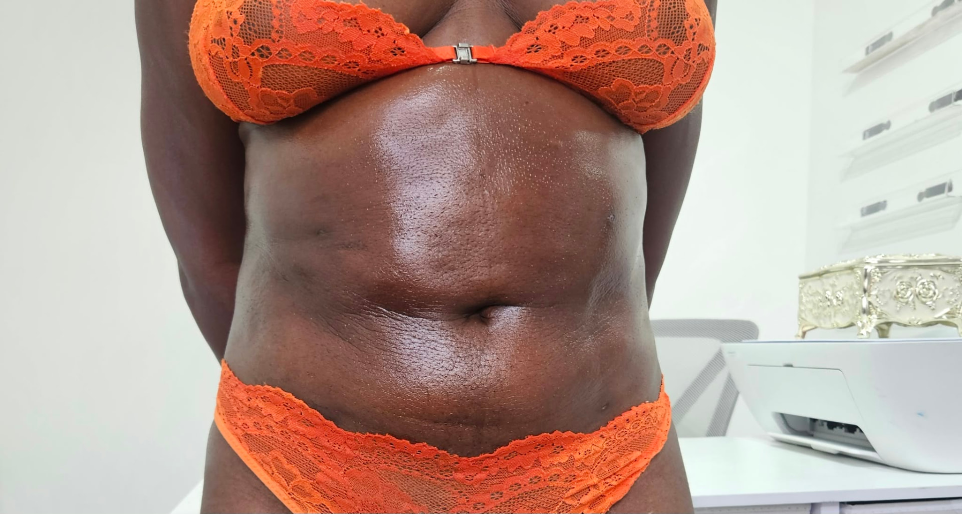 Vaser lipo abdomen result following the post-surgical recovery programme