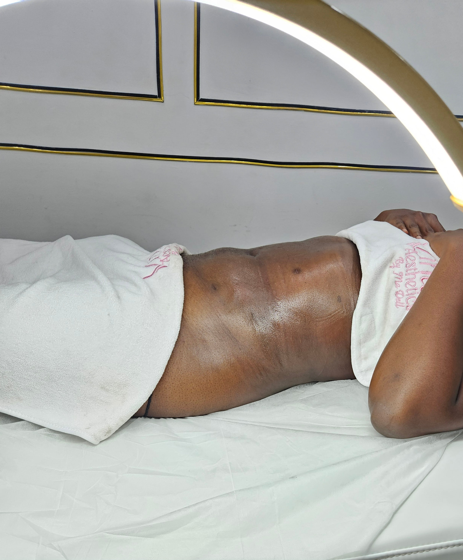 Vaser liposuction abdominal body contouring result at Vintage Aesthetics By Madell