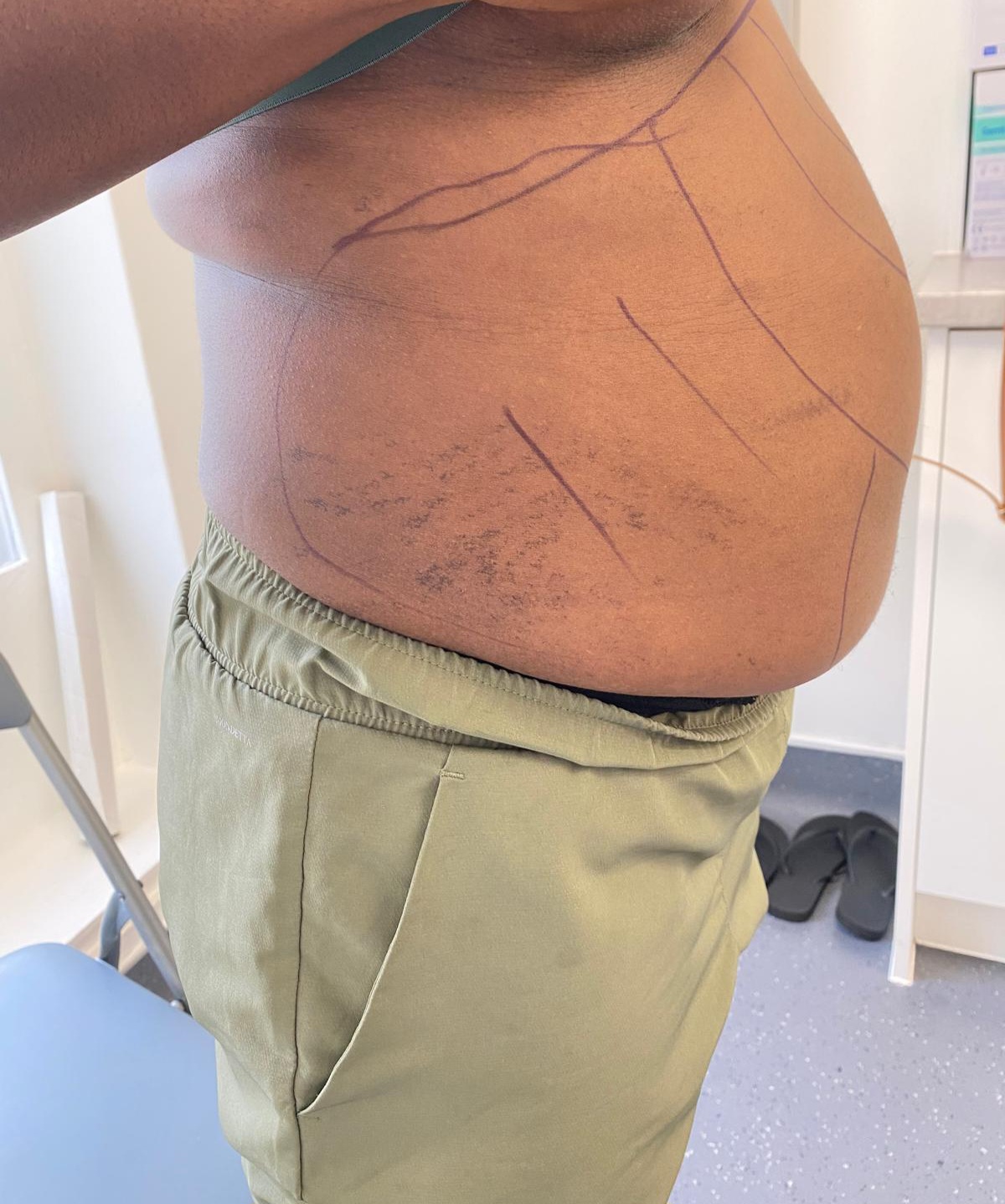 Vaser liposuction treatment mapping marked on the abdomen before body contouring in Enfield