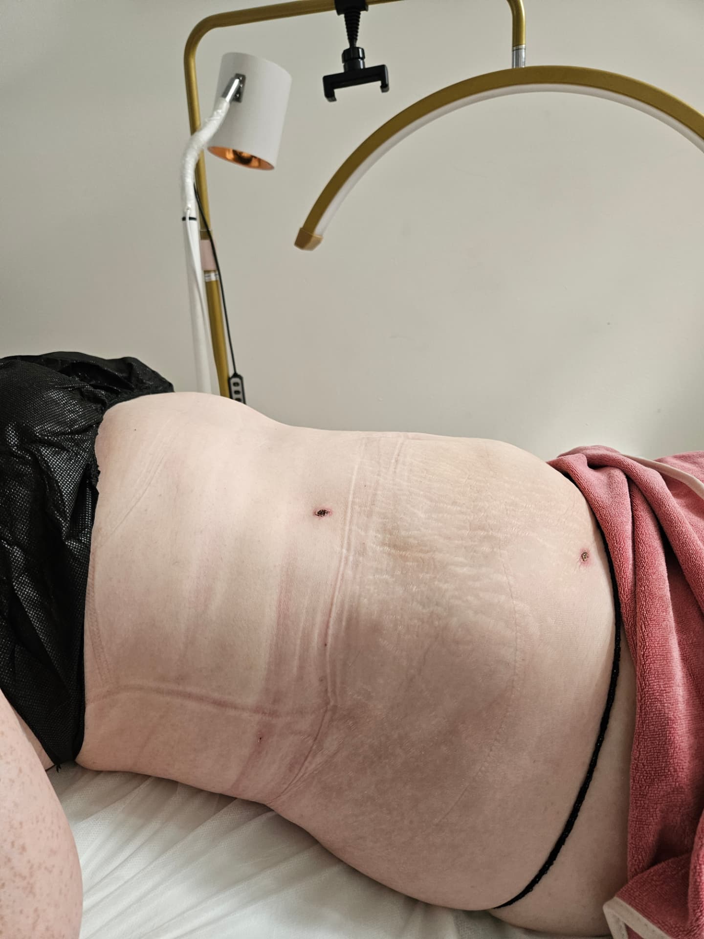 Lymphatic drainage session reducing swelling after liposuction in Enfield