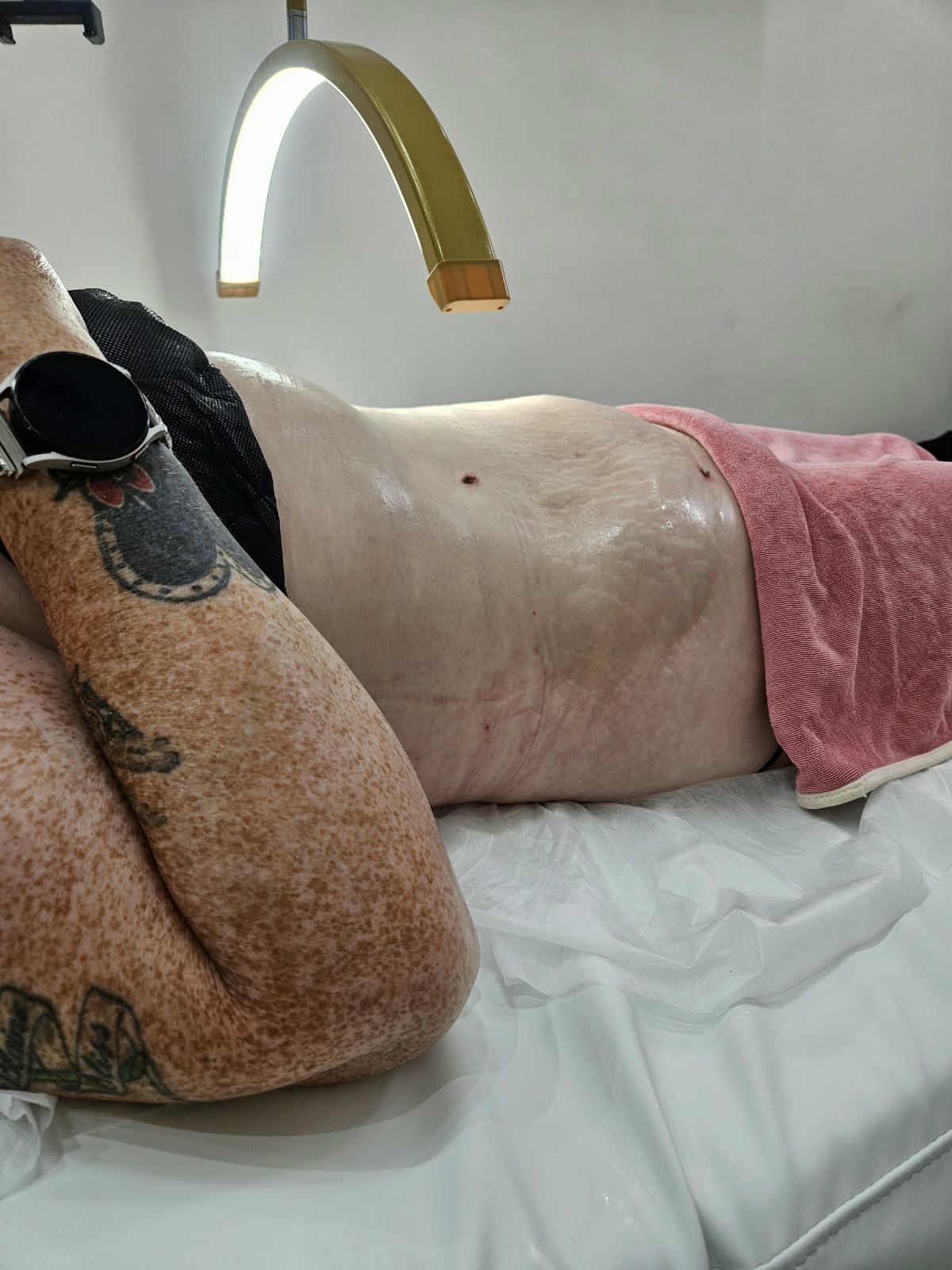 Abdominal lymphatic drainage recovery treatment supporting post-operative healing